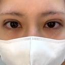 二重埋没 NARU Beauty Clinic 【ナルクリ】 DAY 0 サムネイル用