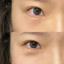 クマ治療 / 下まぶたの脂肪取り 湘南美容クリニック 長野院 DAY 20 サムネイル用