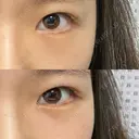 クマ治療 / 下まぶたの脂肪取り 湘南美容クリニック 長野院 DAY 20 サムネイル用