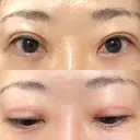 二重切開 / 上まぶたたるみ取り / PRP皮膚再生療法 BRIGHTS beauty clinic DAY 62 サムネイル用