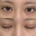 二重埋没 NARU Beauty Clinic 【ナルクリ】 DAY 1 サムネイル用
