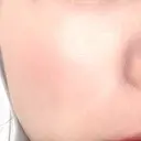 毛穴洗浄（ハイドラフェイシャルなど） 東京素肌クリニック 銀座本院 AFTER サムネイル用