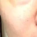 毛穴洗浄（ハイドラフェイシャルなど） 東京素肌クリニック 銀座本院 DAY 31 サムネイル用