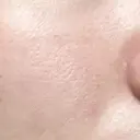 毛穴洗浄（ハイドラフェイシャルなど） 東京素肌クリニック 銀座本院 DAY 32 サムネイル用