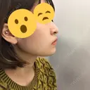 あごプロテーゼ 恵聖会クリニック 京橋院 DAY 20 サムネイル用