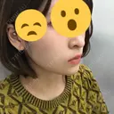 あごプロテーゼ 恵聖会クリニック 京橋院 DAY 20 サムネイル用