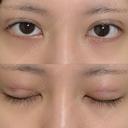 二重埋没 NARU Beauty Clinic 【ナルクリ】 DAY 2 サムネイル用