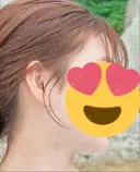 糸リフト / 脂肪吸引（顔） 湘南美容クリニック 大阪心斎橋院 DAY 520 サムネイル用