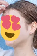 糸リフト / 脂肪吸引（顔） 湘南美容クリニック 大阪心斎橋院 DAY 520 サムネイル用