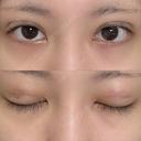 二重埋没 NARU Beauty Clinic 【ナルクリ】 DAY 3 サムネイル用