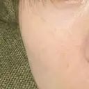 毛穴洗浄（ハイドラフェイシャルなど） 東京素肌クリニック 銀座本院 DAY 89 サムネイル用