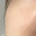 毛穴洗浄（ハイドラフェイシャルなど） 東京素肌クリニック 銀座本院 DAY 119 サムネイル用