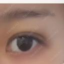 二重埋没 NARU Beauty Clinic 【ナルクリ】 DAY 10 サムネイル用