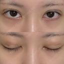 二重埋没 NARU Beauty Clinic 【ナルクリ】 DAY 4 サムネイル用
