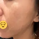 美肌レーザー / シミ取りレーザー あいちビューティークリニック DAY 8 サムネイル用