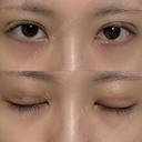 二重埋没 NARU Beauty Clinic 【ナルクリ】 DAY 5 サムネイル用