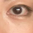 下まぶたの脂肪取り おきなわ美容クリニック AFTER サムネイル用