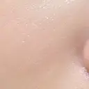 ピーリング（ニキビ・毛穴） / 毛穴洗浄（ハイドラフェイシャルなど） 表参道メディカルクリニック 銀座院 AFTER サムネイル用