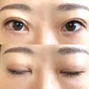 二重切開 / 上まぶたたるみ取り / PRP皮膚再生療法 BRIGHTS beauty clinic DAY 70 サムネイル用