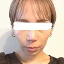 鼻尖形成（切開） / 鼻中隔延長（切開） / 軟骨移植 / 鼻翼基部形成（貴族手術） / 鼻柱下降・鼻唇角形成（猫手術） MAe Clinic 東京院 DAY 13 サムネイル用