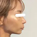 鼻尖形成（切開） / 鼻中隔延長（切開） / 軟骨移植 / 鼻翼基部形成（貴族手術） / 鼻柱下降・鼻唇角形成（猫手術） MAe Clinic 東京院 DAY 13 サムネイル用