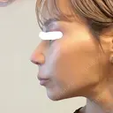 鼻尖形成（切開） / 鼻中隔延長（切開） / 軟骨移植 / 鼻翼基部形成（貴族手術） / 鼻柱下降・鼻唇角形成（猫手術） MAe Clinic 東京院 DAY 13 サムネイル用