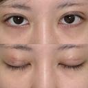 二重埋没 NARU Beauty Clinic 【ナルクリ】 DAY 8 サムネイル用