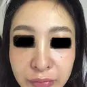 ピコレーザートーニング（美白・肝斑） ルラ美容クリニック 高田馬場院 DAY 6 サムネイル用