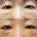 クマ治療 / 脂肪注入（肌） / ボトックス（あご） 銀座みゆき通り美容外科 大阪梅田院 DAY 3 サムネイル用