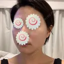 脂肪溶解注射（顔） 聖心美容クリニック 福岡院 DAY 1 サムネイル用