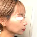 鼻尖形成（切開） / 鼻中隔延長（切開） / 軟骨移植 / 鼻翼基部形成（貴族手術） / 鼻柱下降・鼻唇角形成（猫手術） MAe Clinic 東京院 DAY 16 サムネイル用