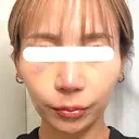 鼻尖形成（切開） / 鼻中隔延長（切開） / 軟骨移植 / 鼻翼基部形成（貴族手術） / 鼻柱下降・鼻唇角形成（猫手術） MAe Clinic 東京院 DAY 16 サムネイル用