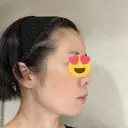 ヒアルロン酸注入（頬） BRIGHTS beauty clinic AFTER サムネイル用
