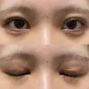 二重切開 / 目頭切開 / クマ治療 / 上まぶたの脂肪取り / 下まぶたの脂肪取り / タレ目形成・グラマラスライン（切開） BRIGHTS beauty clinic AFTER サムネイル用