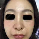 ピコレーザートーニング（美白・肝斑） ルラ美容クリニック 高田馬場院 AFTER サムネイル用