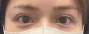 二重埋没 BELINDA CLINIC（ベリンダクリニック）新宿院 DAY 0 サムネイル用