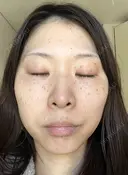 シミ取りレーザー フローラクリニック DAY 3 サムネイル用