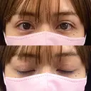 二重埋没 BELINDA CLINIC（ベリンダクリニック）新宿院 DAY 1 サムネイル用