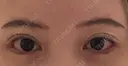 目尻切開 / タレ目形成・グラマラスライン（切開） JUN CLINIC AFTER サムネイル用