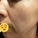 美肌レーザー / シミ取りレーザー あいちビューティークリニック AFTER サムネイル用