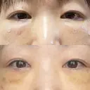 クマ治療 / 脂肪注入（肌） / ボトックス（あご） 銀座みゆき通り美容外科 大阪梅田院 DAY 7 サムネイル用