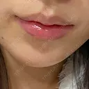 小鼻縮小（切開） / 口唇縮小術 / 口角挙上 / その他（鼻） / その他（口元） B-LINE CLINIC 池袋院 AFTER サムネイル用