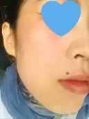 ボトックス（エラ・小顔） / ハイフ（顔） 美容皮膚科エルムクリニック 大阪院 DAY 11 サムネイル用