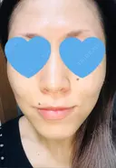 ボトックス（エラ・小顔） / ハイフ（顔） 美容皮膚科エルムクリニック 大阪院 DAY 9 サムネイル用