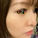 アートメイク（ほくろ） oneUPclinic DAY 0 サムネイル用