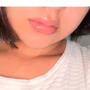 ヒアルロン酸注入（唇） / ボトックス（口角） ルラ美容クリニック 名古屋本院 DAY 1 サムネイル用