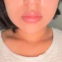 ヒアルロン酸注入（唇） / ボトックス（口角） ルラ美容クリニック 名古屋本院 DAY 1 サムネイル用