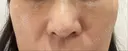 隆鼻術 / 鼻中隔延長（切開） / タレ目形成・グラマラスライン（切開） / 軟骨移植 / 脂肪注入（額） リッツ美容外科 東京院 AFTER サムネイル用