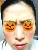 ボトックス（額） 美容皮膚科エルムクリニック 大阪院 DAY 10 サムネイル用