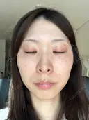 シミ取りレーザー フローラクリニック AFTER サムネイル用